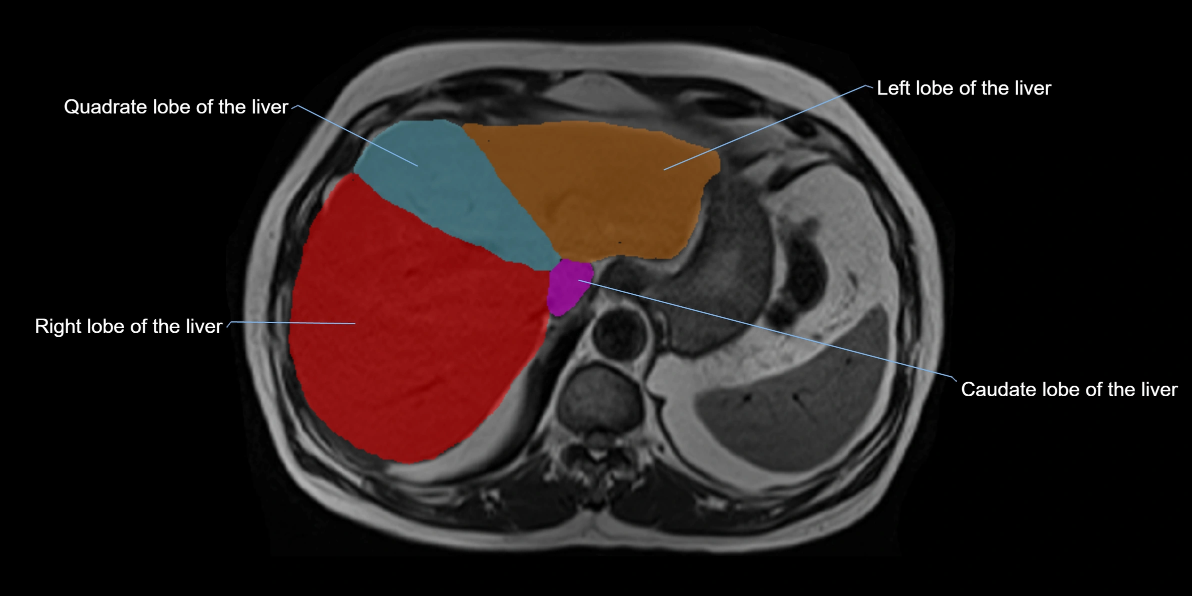 MRI liver lobe axial cross sectional 3T radiology  image-img-00001-00009.webp